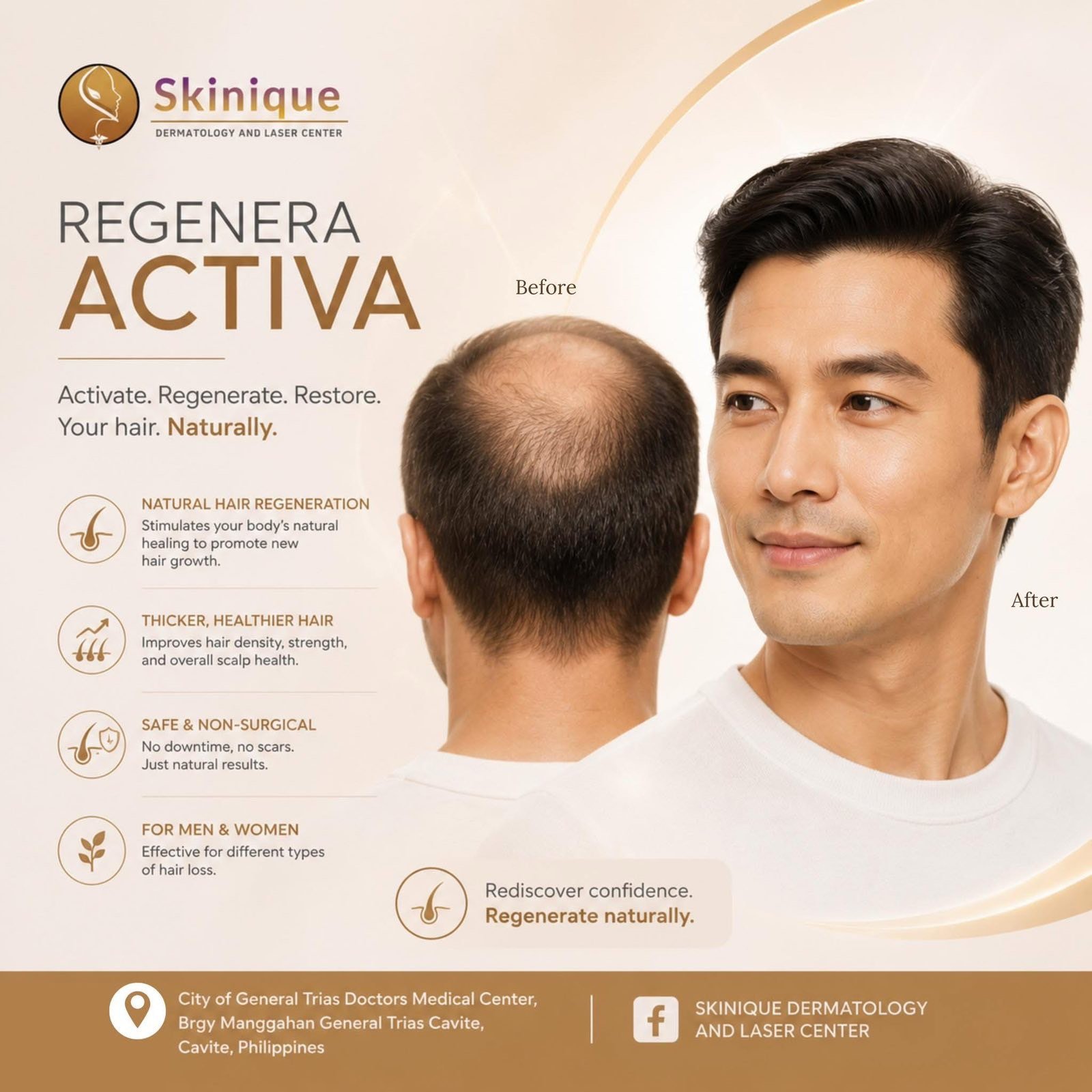 Regenera Activa poster: before and after photographs of a man’s hairline, with natural hair regeneration, thicker hair, and non-surgical treatment listed